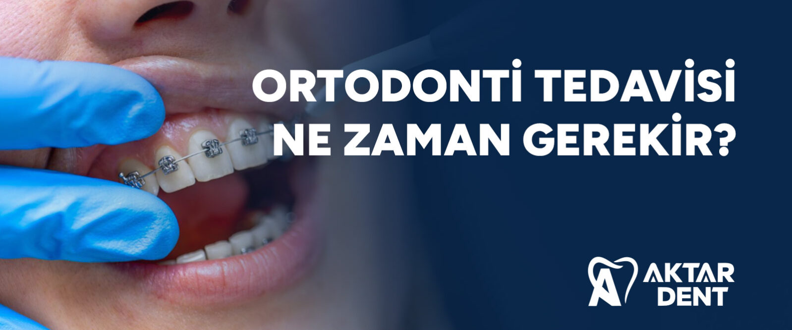 ortodonti-tedavisi-ne-zaman-gerekir-gorsel